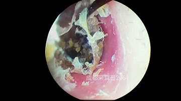 Relax Everyday With Satisfying Ear Wax Removal #041
